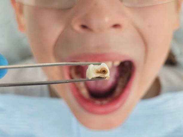 Best Urgent Care for Lost Fillings or Crowns in Mountain Home, NC